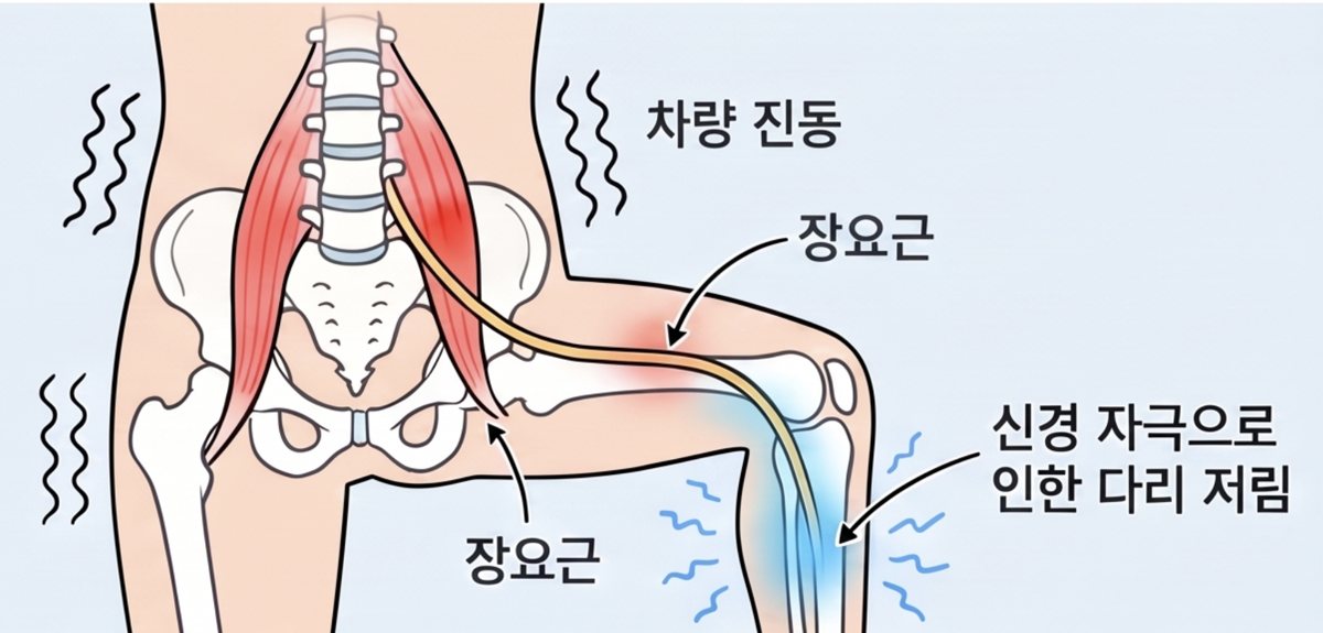 장요근과 요추신경총, 다리 저림을 설명하는 해부 그림